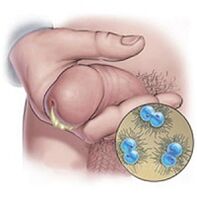 discharge of gonorrhea